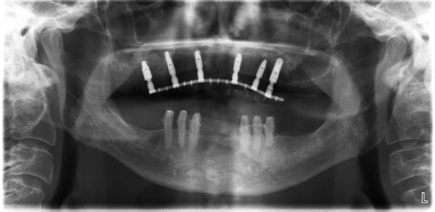 Implantace 6 implantátů v horní čelisti s následně v ústech svařovanou konstrukcí