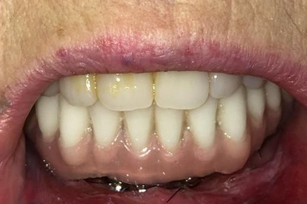 Můstek se svařovanou konstrukcí v ústech pacienta